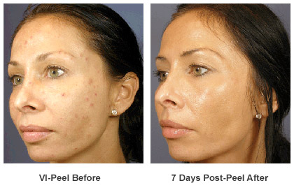 VI Peel before and after results