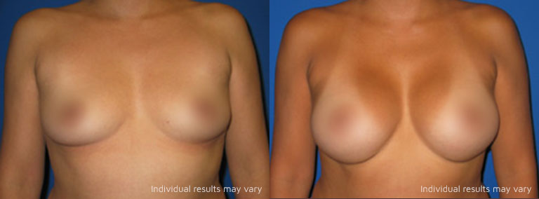Breast Augmentation 01 Patient Before