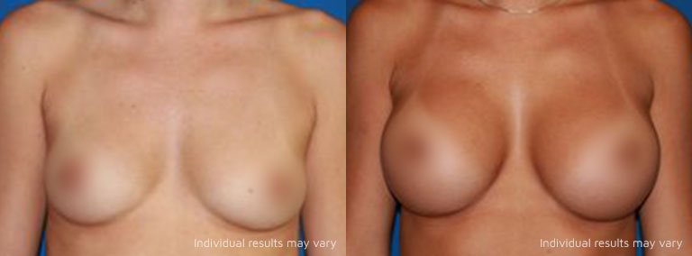 Breast Augmentation 01 Patient After