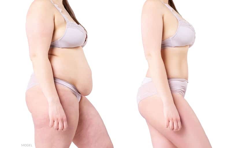 Liposuction vs Tummy Tuck, In modern day and age, enhancing one's  aesthetic quotient has become a principal concern for many individuals. To  get rid of the body fat and get in
