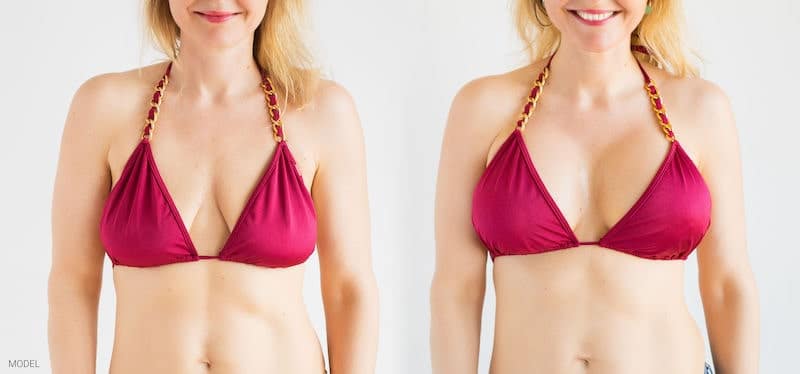 Can Sagging Breasts be Improved with Breast Augmentation Surgery?
