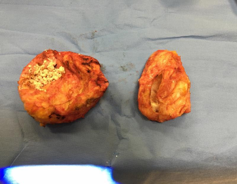 Capsules removed from breasts affected by capsular contracture